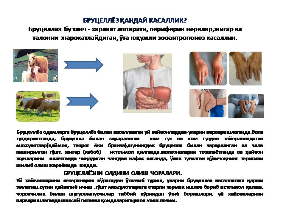 Бруцеллёз қандай касаллик